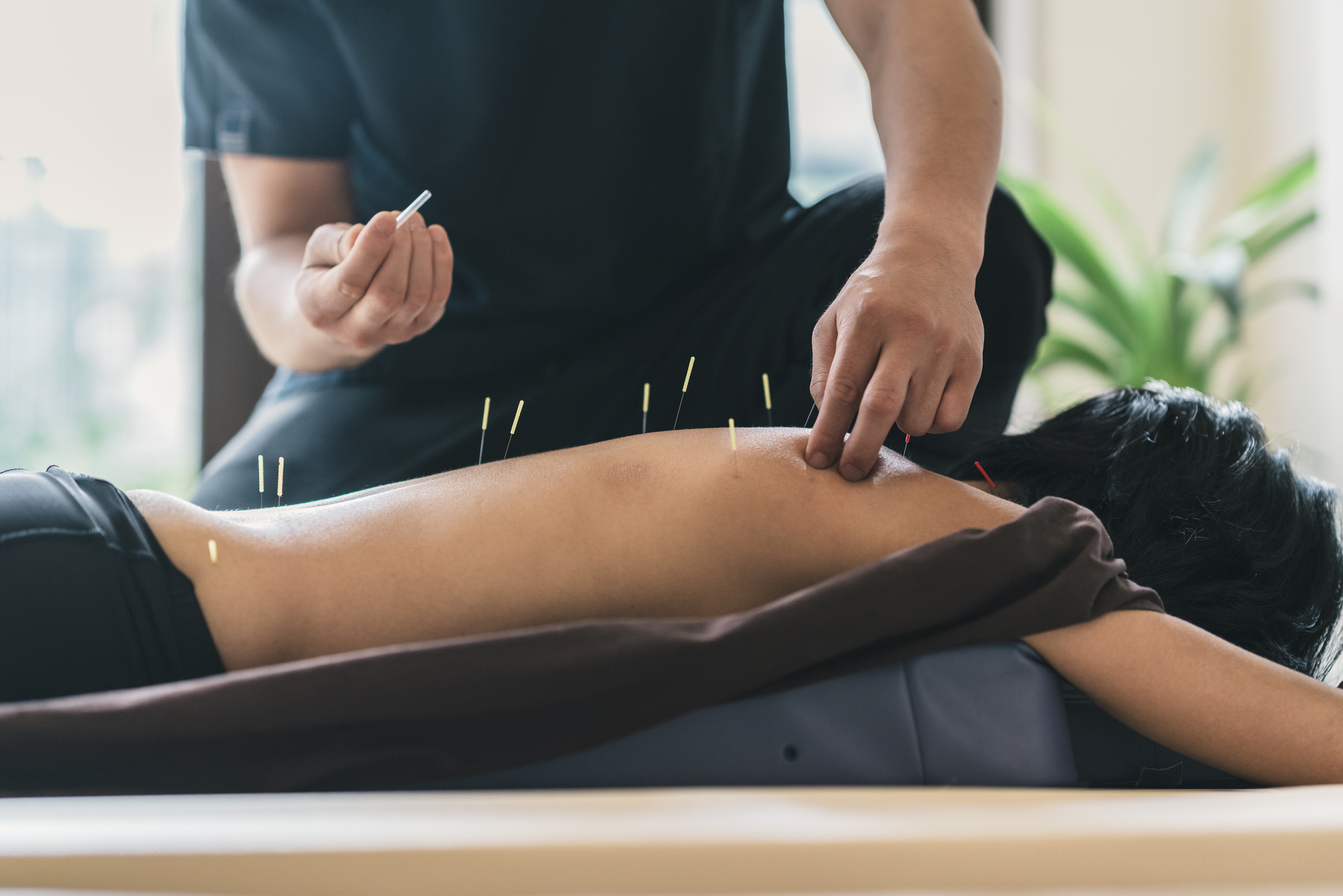 Acupuncture image 1
